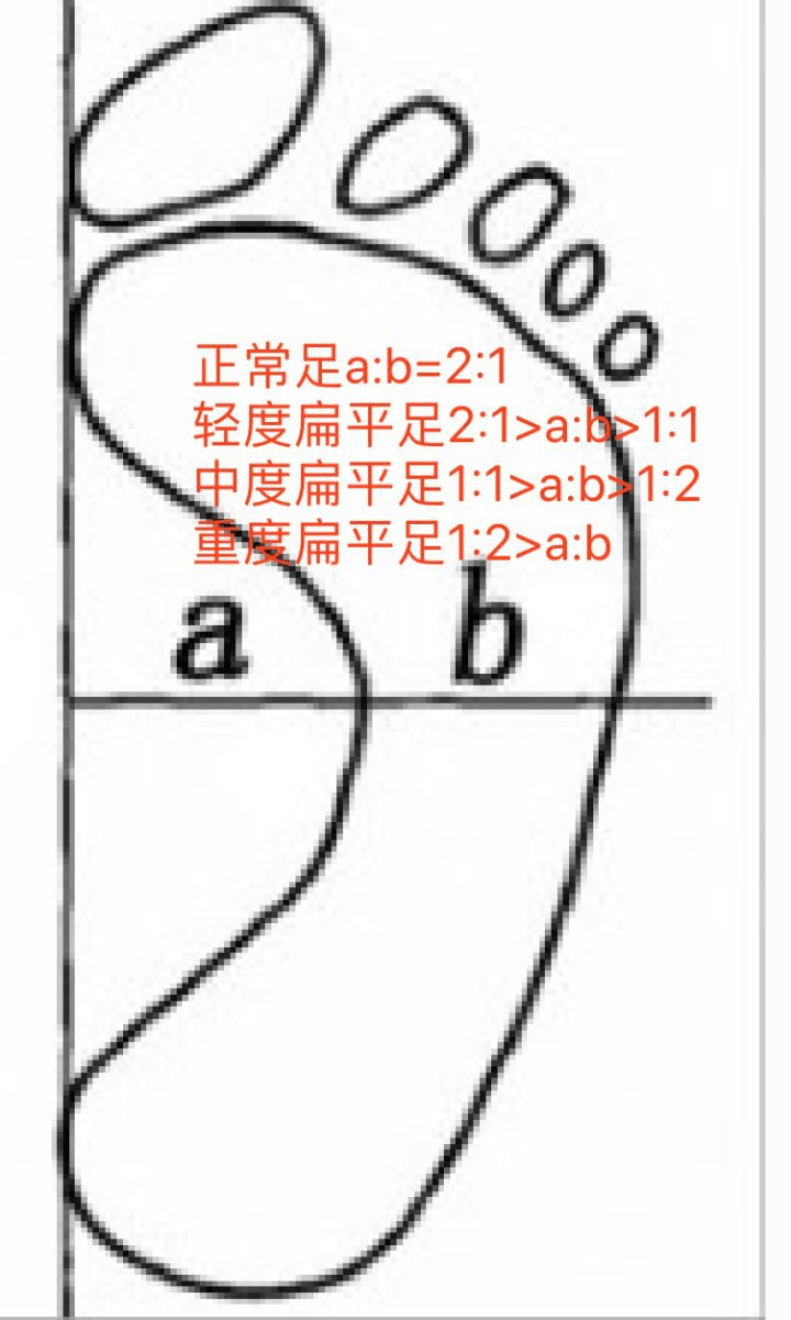 2,检测是否为"正常足弓"的方法休闲鞋的鞋楦前跷较高,容易引起脚掌