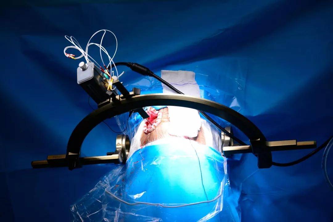 全国首例!5g远程人体手术顺利完成!_患者