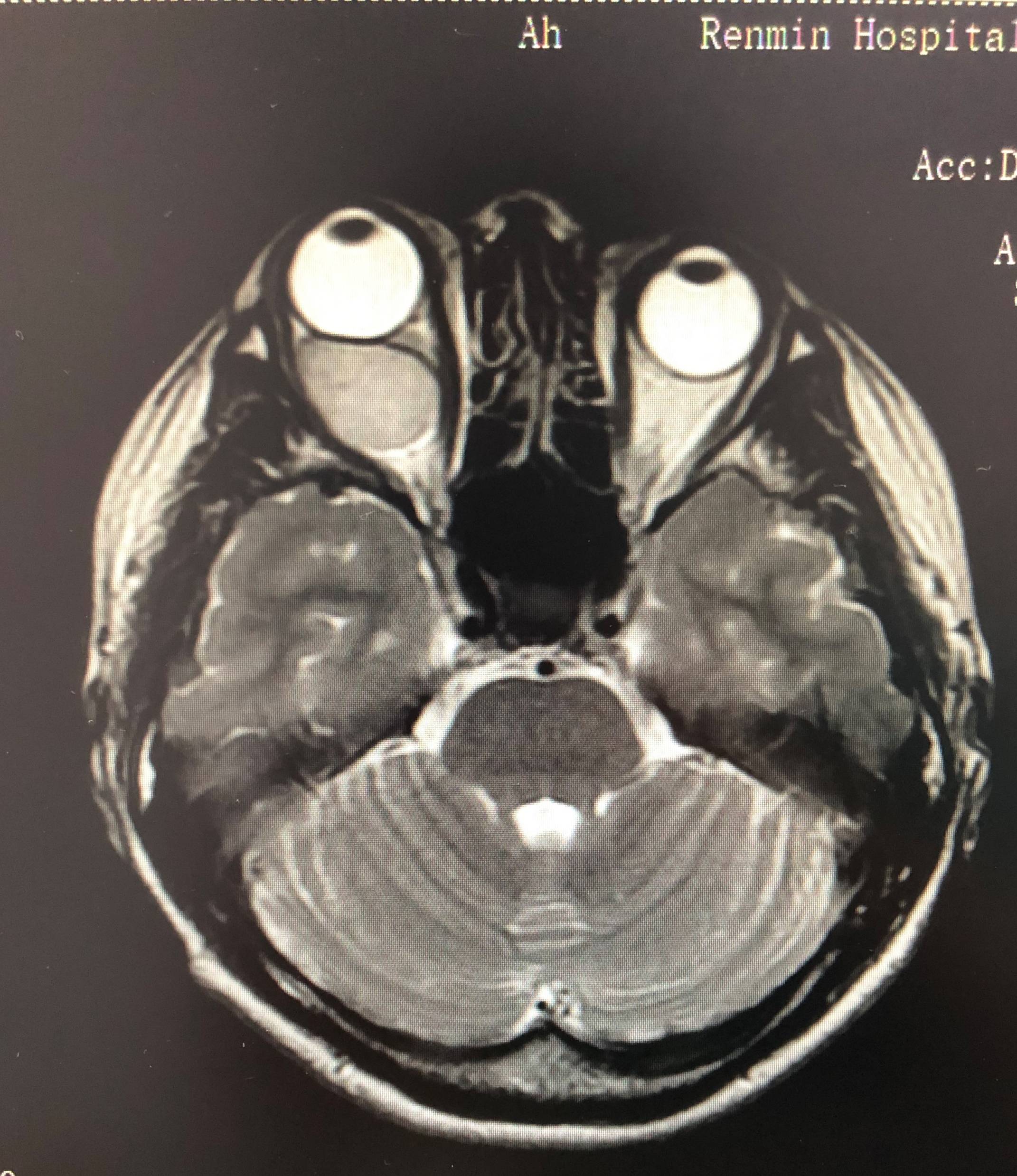 时偶尔发现自己"脸歪了",去医院检查后才知道,竟然是眼眶肿瘤在作祟