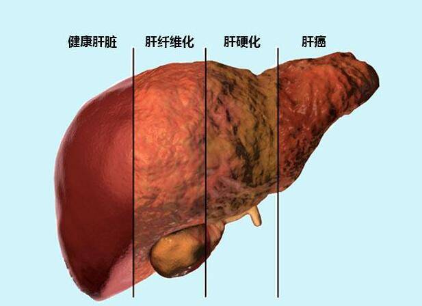 肝纤维化皮肤图片图片