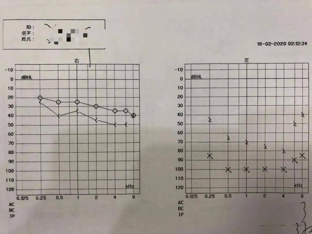 案例分享|癔病性耳聾:主,客觀檢查結果不一致,真不是故意為之!_聽力