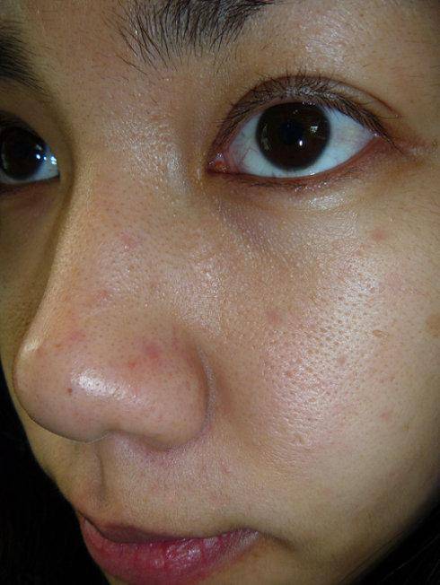 皮肤敏感怎么办学会6步预防皮肤过敏远离毁容节奏