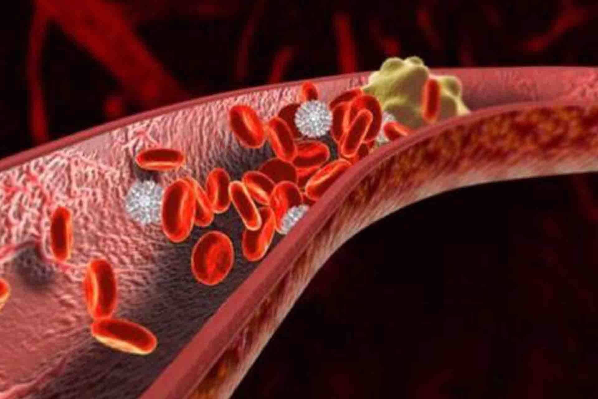 血栓栓塞在腿上的后果是(腿部血栓堵塞严重后果是什么) - 医药经