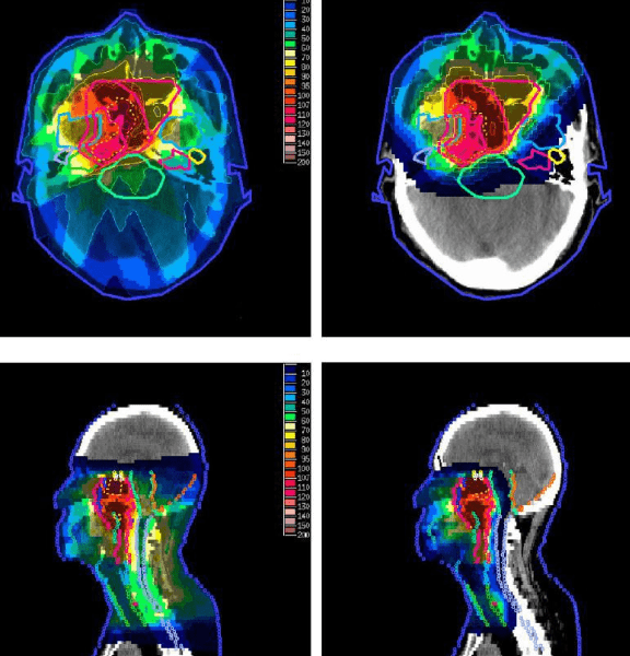 鼻咽癌做放疗:这些放疗知识家属需要了解_手机搜狐网