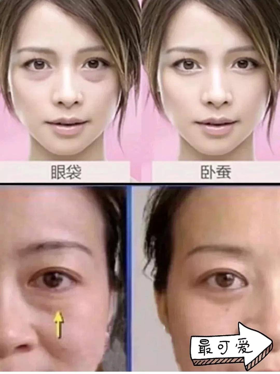 美业赵勤——一分钟教你分变眼袋跟卧蚕_手机搜狐网