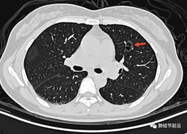 肺結節讀片(12):容易忽視的囊腔樣肺腺癌的ct特點