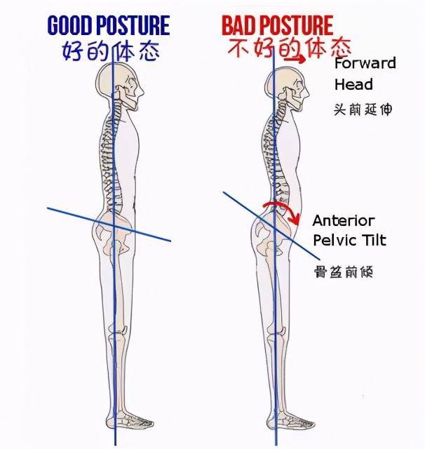 为什么会骨盆前倾图片
