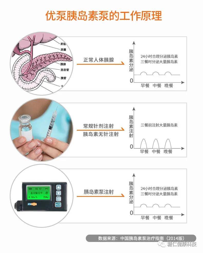 化疗泵使用图解图片