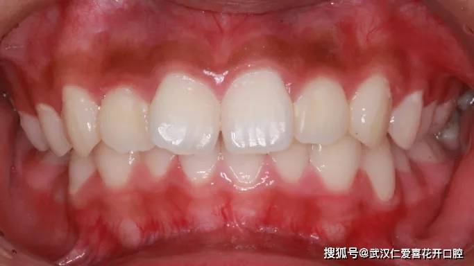 基本情况 吴xx 女,17岁 主诉:要求矫正牙列不齐,前突 现病史:恒牙列