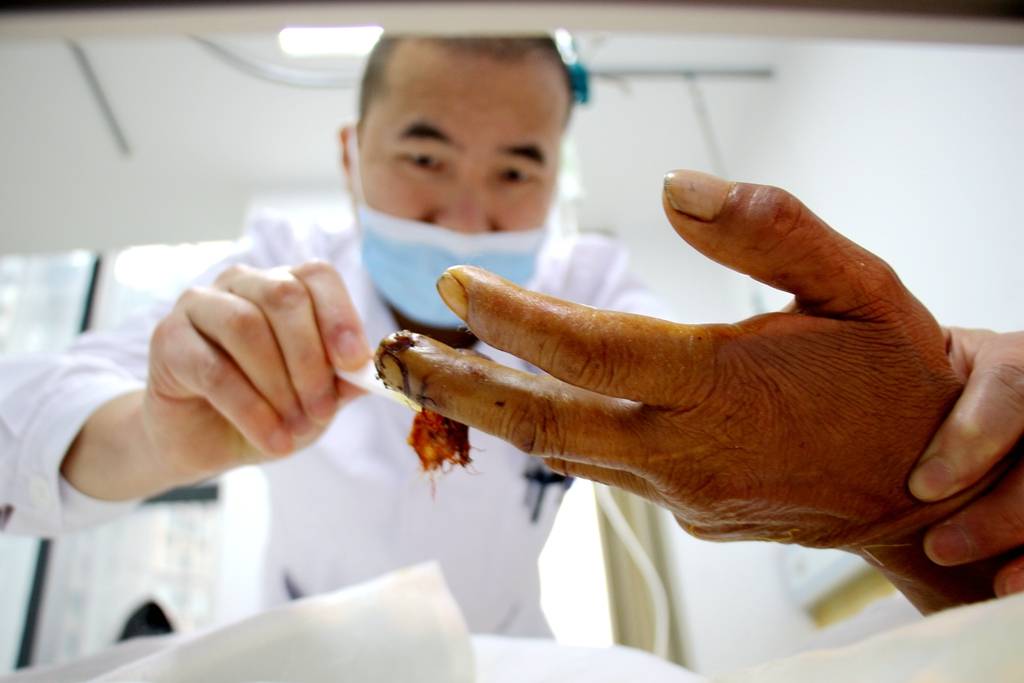 长航东院骨科郭建利笑着说你的手指头活啦