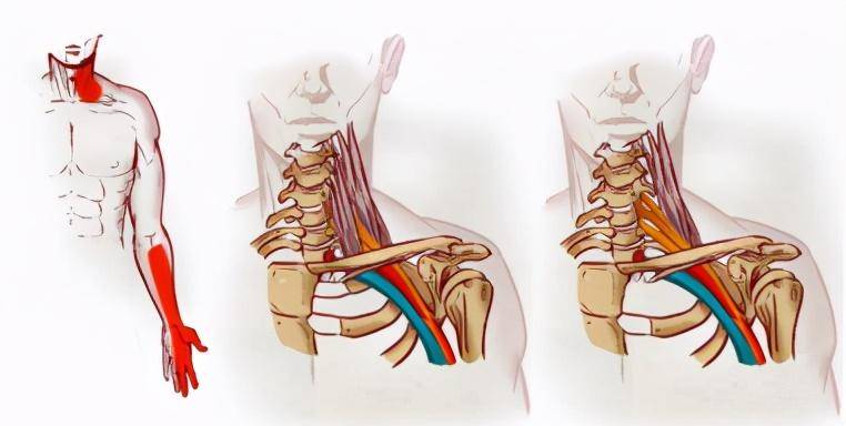 手臂酸痛麻?可能是胸廓出口综合征