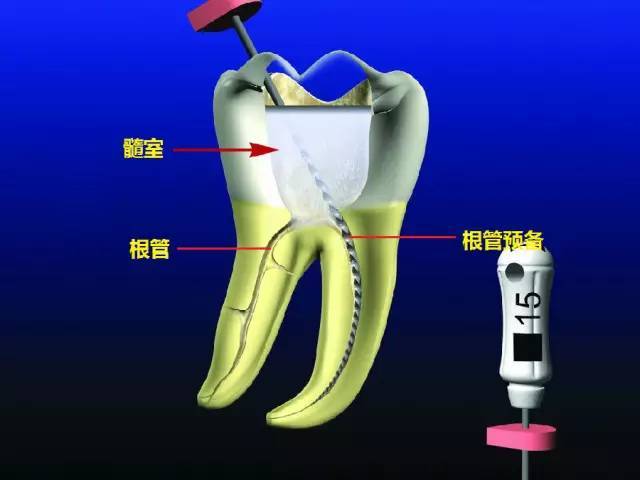 牙根管治療是由牙醫通過專用儀器進行的,徹底清除牙齒內的感染牙髓