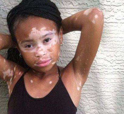 白癜风这种病不知道大家都看过吗?