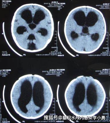餵奶後再次噴射性嘔吐,就診于吉林省琿春市某醫院,頭顱ct:腦積水(片子