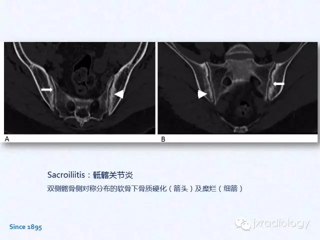 骶髂关节炎x线ct和mri表现
