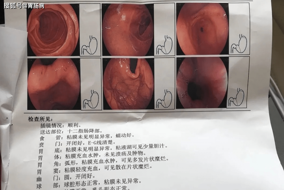 萎缩性胃炎,是胃缩小了么?一定会癌变吗?能治好吗?