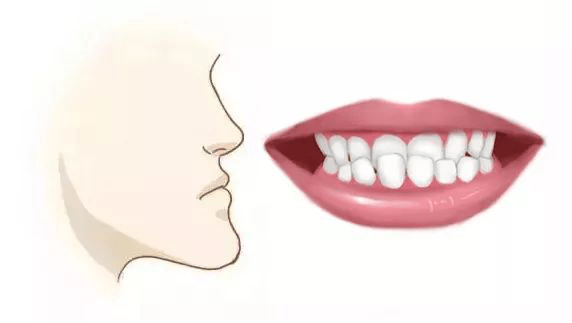 大连齿医生口腔科普牙齿畸形可导致脸型变丑揭露你不知的牙齿与脸型的