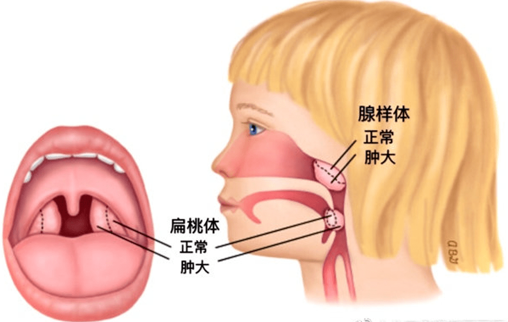 如果孩子鼻腔後部被肥大的腺樣體堵塞了,通常會以口呼吸代償,保障供氧