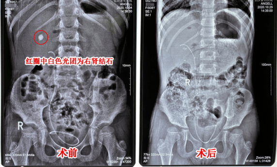 8岁女童零食不断喝水少,体检竟发现双肾长结石