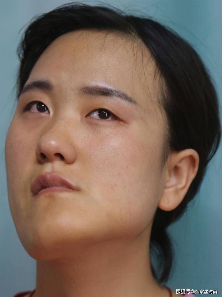 在几天的治疗下,赵宏秋的病情渐渐地得到了控制,可