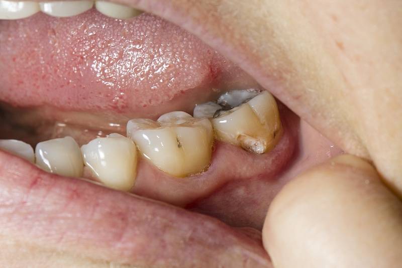 我牙齿上只是小小的洞,为什么牙医还要将它磨大?