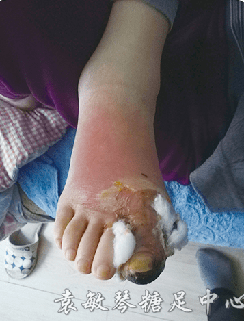 糖尿病患者选择宽松的鞋袜可以有效预防糖尿病足的发生!