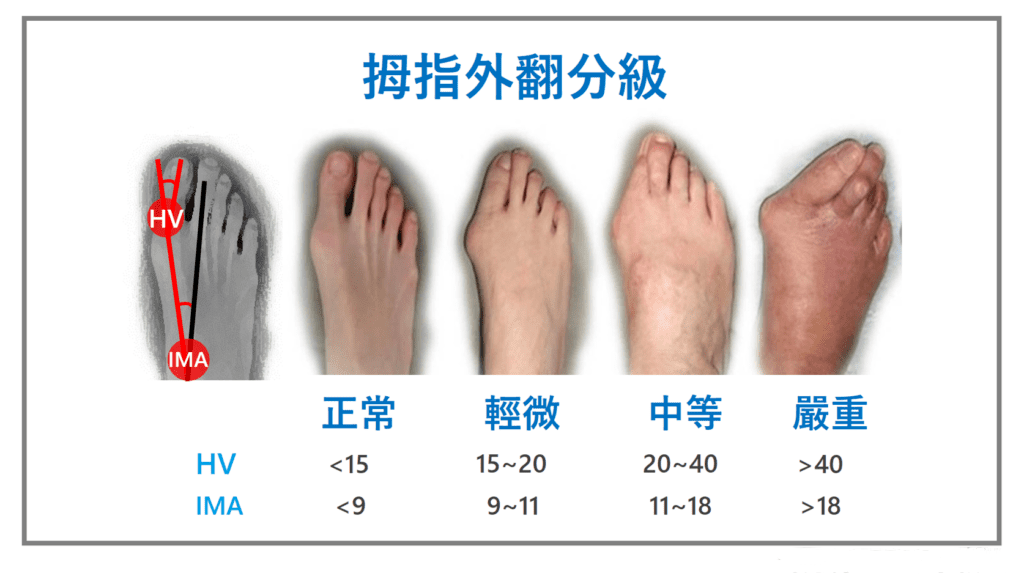 足趾畸形分类图片