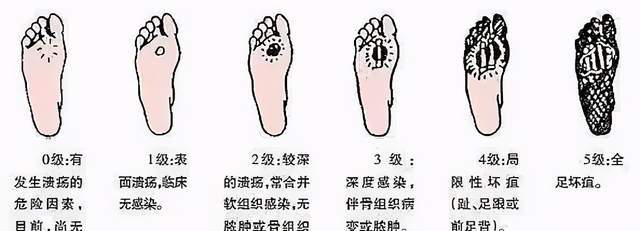 糖尿病足分级糖尿病足是发生于糖尿病患者的足和腿部组织破坏的一种