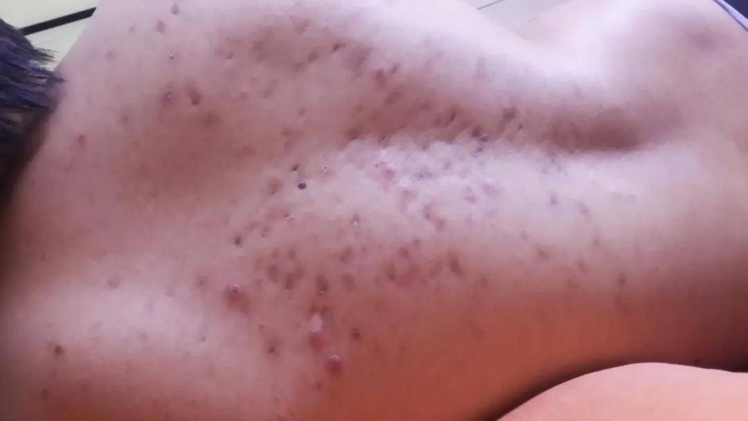 后背痘痘怎么去除