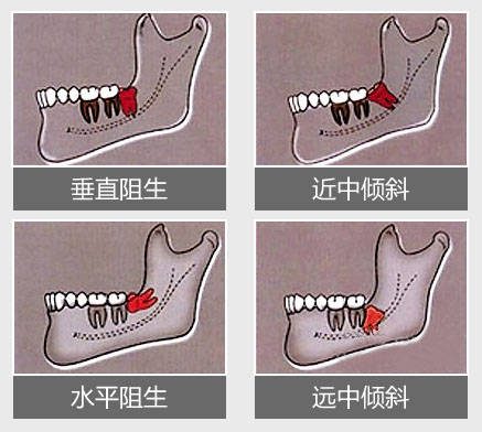 拔牙過多會導致死亡?_智齒