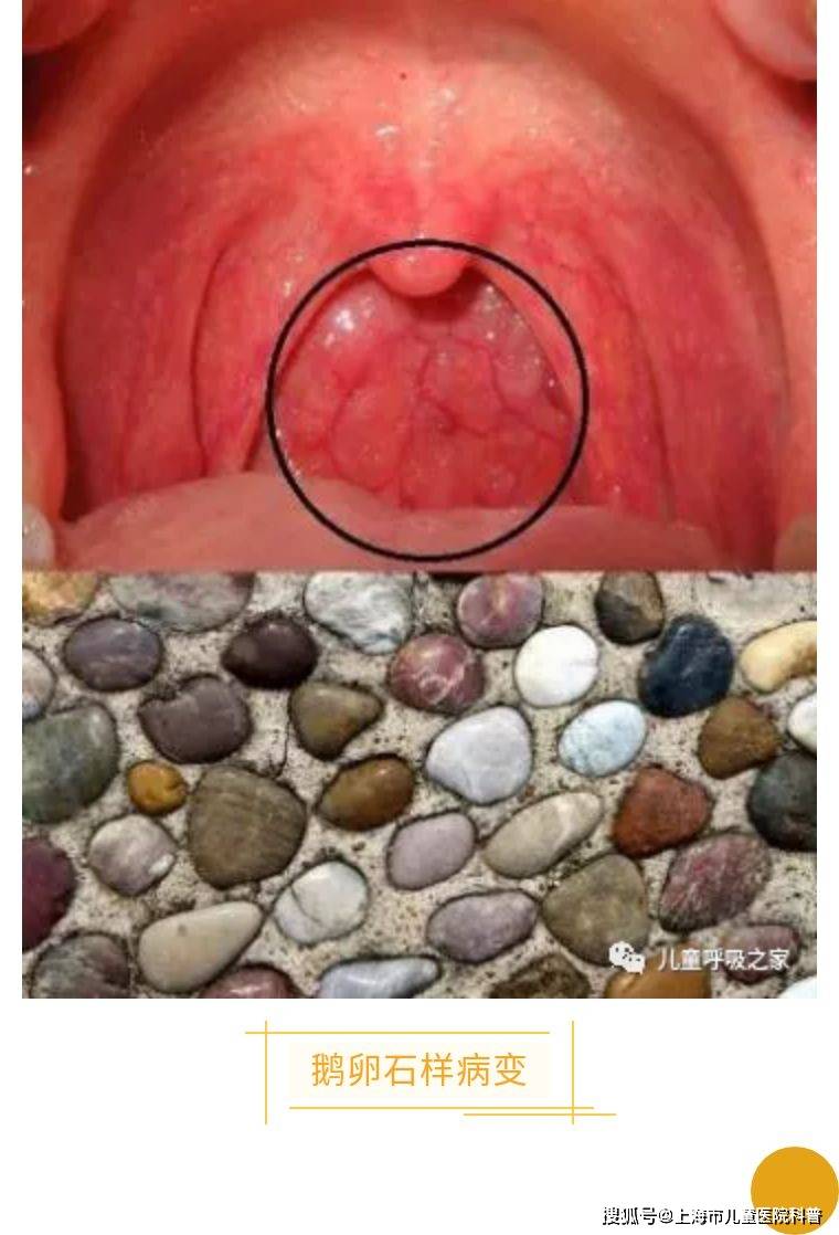 喉咙里有红色疙瘩图片图片