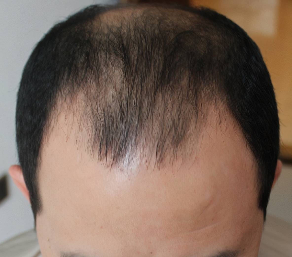 25岁男子脱发6年发际线头顶严重脱发相亲十多次全失败