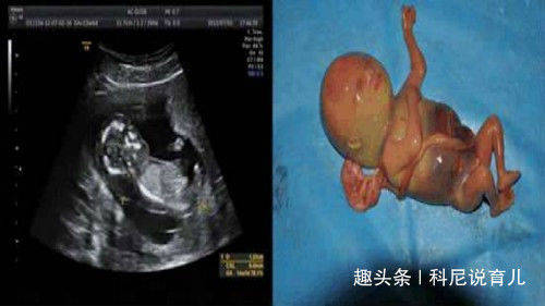 四个月胎儿图片引产图片