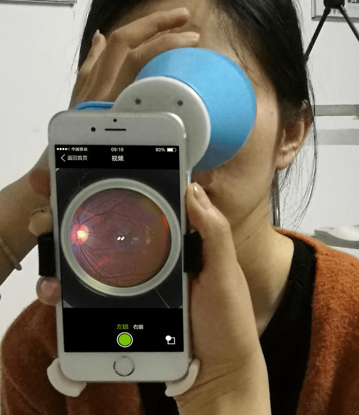 直接检眼镜与间接检眼镜如何选