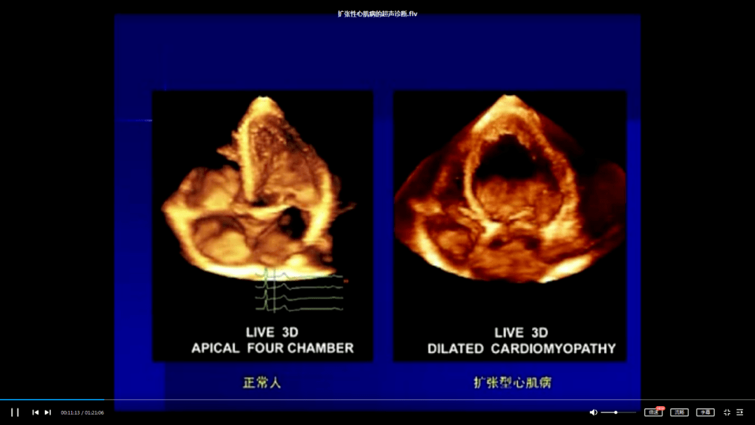 房间隔缺损超声心动图诊断的种种陷阱 / 二维超声心动图测量与计算