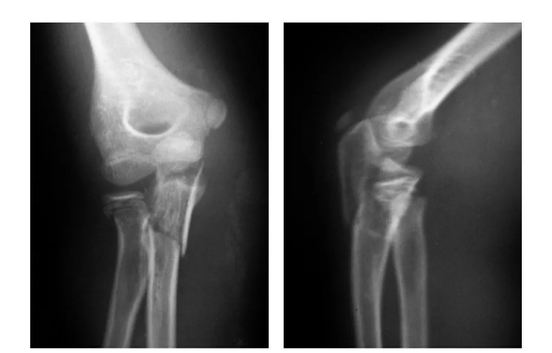 7种67肘部损伤x片详细图解