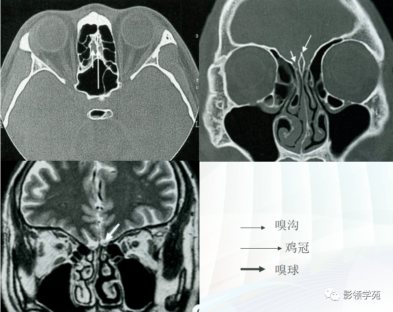 the ethmoid bone(筛骨)包括盲孔和筛孔蝶骨小翼和鞍结节为后界额骨