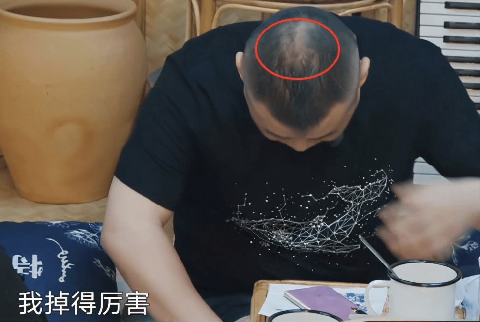 当时岳云鹏对着镜头低头的时候,还只是后脑勺上有一点稀疏,大家还调侃