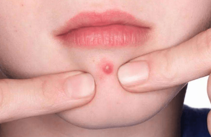 脸上长痘常年不消的人一定有以下几个习惯中一个痘痘都好不了