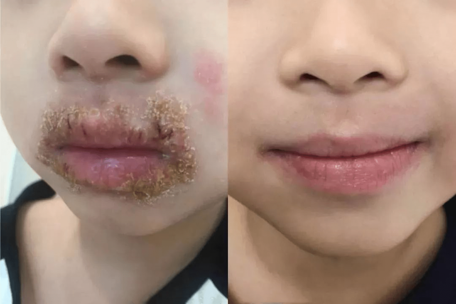 因为1个习惯动作,5岁男童被抽血4次,这个安全隐患宝妈快自查_嘴唇