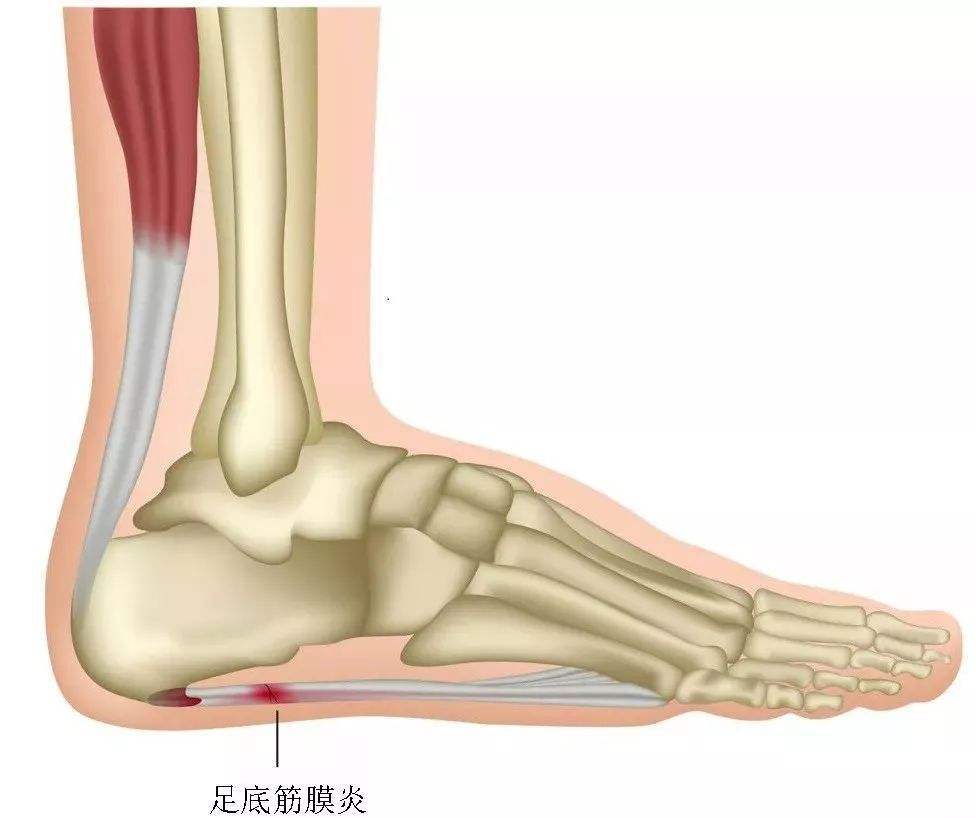 足底筋膜炎的位置图图片