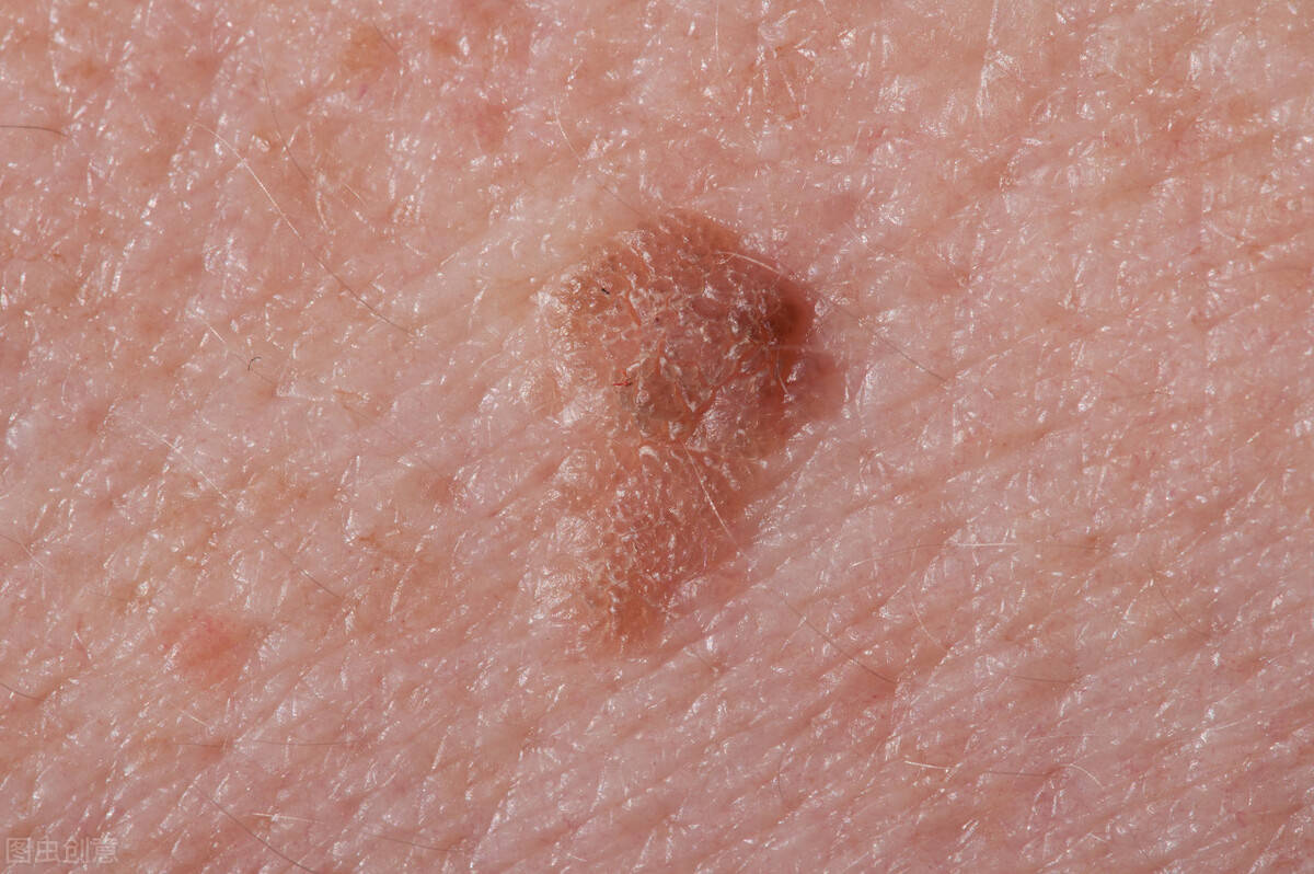 菜花状的疙瘩,这多半是感染hpv之后引起的疣体,也称为尖锐湿疣.