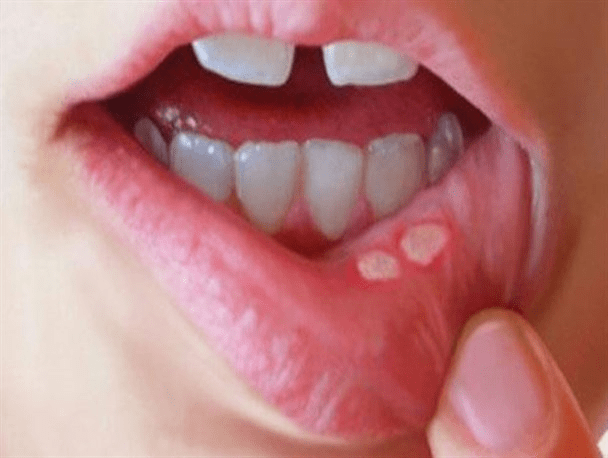 爱牙网为什么口腔溃疡被称为绝症治疗口腔溃疡的小窍门是什么