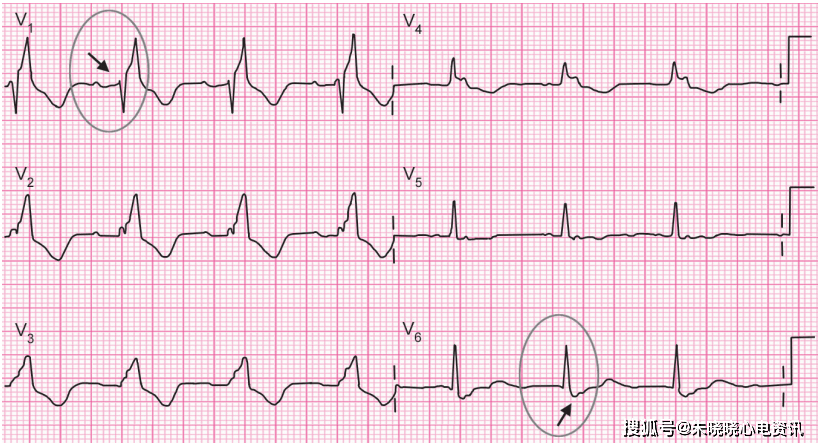 2分钟读懂左右束支传导阻滞心电图学习一日通