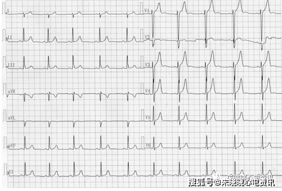a 左右手反接描记心电图⒋v1,v2导联不可有q波,但偶可呈qs型,v3 导联