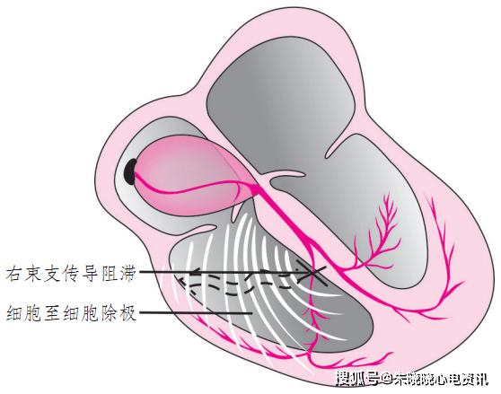 2分钟读懂左、右束支传导阻滞 |心电图学习一日通_心室
