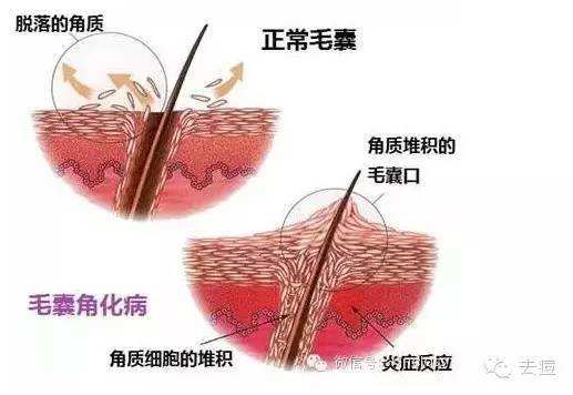 毛囊角化症的發生原因_皮膚