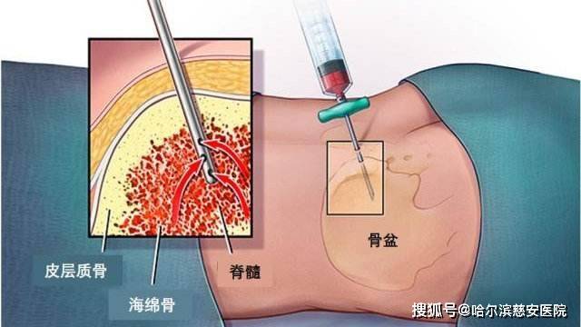 骨髓穿刺点体表定位图图片