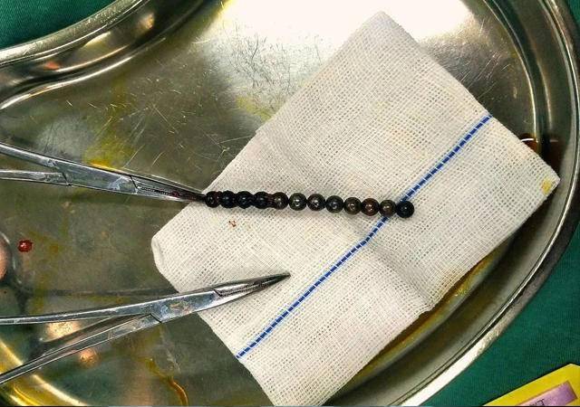 磁力珠被孩子误食后会发生什么答有可能肠道会乱套