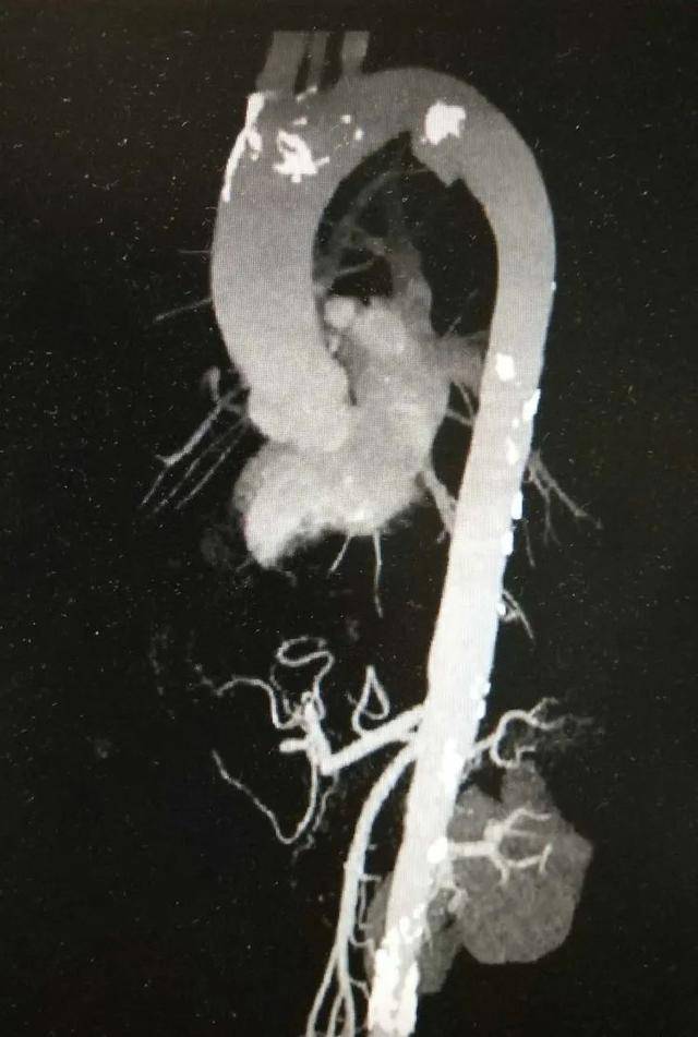 主动脉假性动脉瘤破裂,潍坊市中医院覆膜支架腔内修复术化险为夷